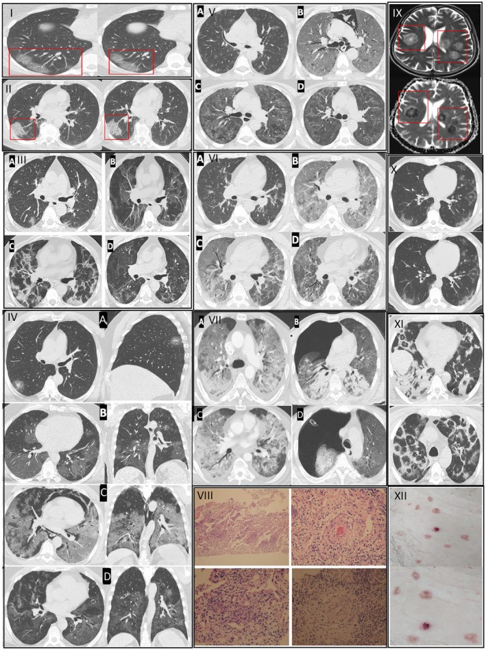 ‘Damar tıkanıklıkları genç yaşlara indi’