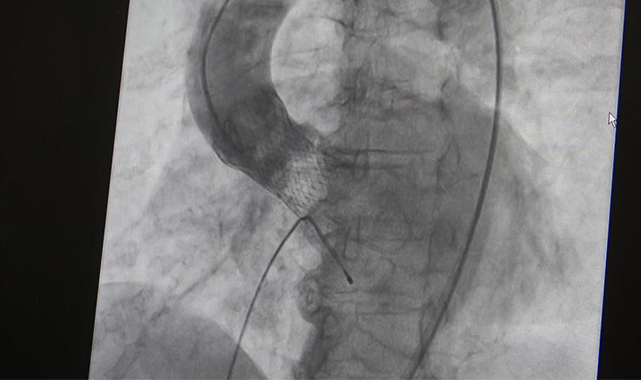 82 yaşındaki Gürcü Samsun’da TAVİ işlemiyle hayata döndü