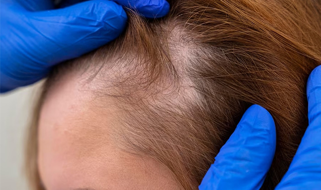 Uzmandan uyarı: 'Saçkıran' olabilirsiniz!