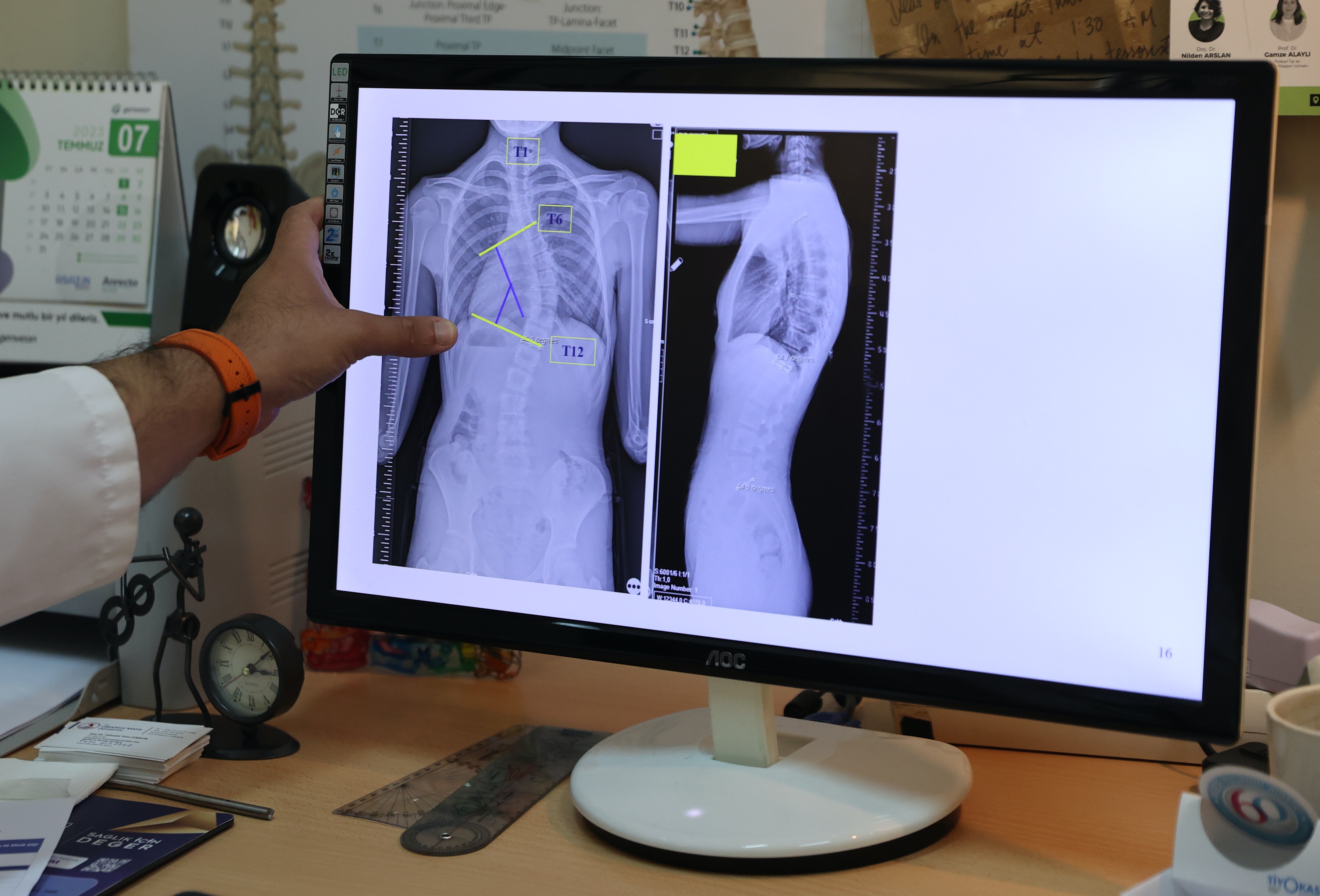 Ergenlik öncesi kontrol omurga eğriliğinin tedavi şansını artırıyor!