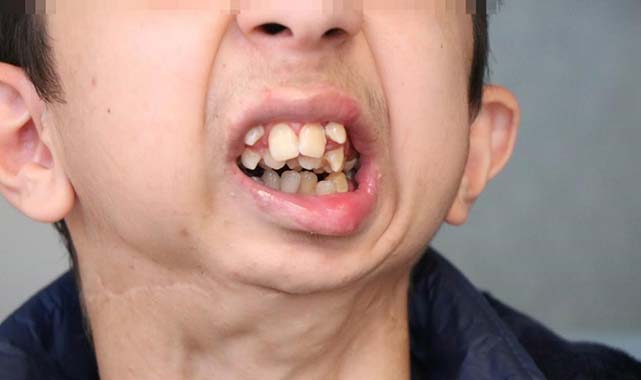 Samsun'da alt çenesi olmayan genç ameliyat için yardım bekliyor