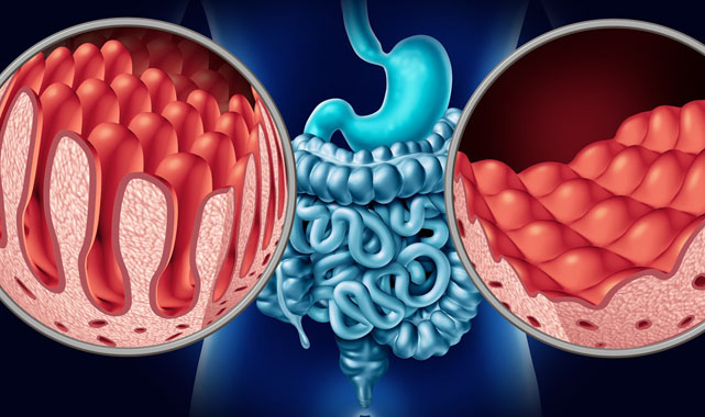 ÇAĞIN VEBASI: ÇÖLYAK