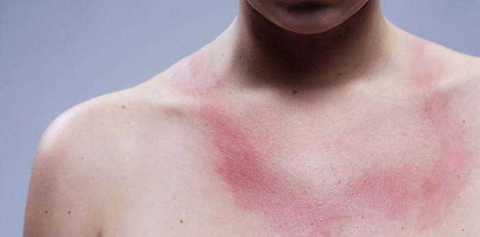 Behçet Hastalığı Nedir?