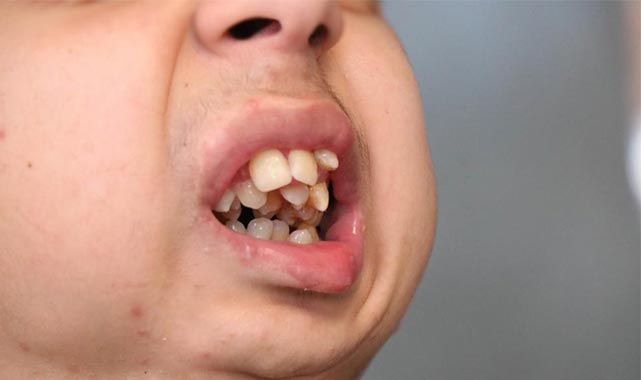 Çene ameliyatı ile hayat yeni bir başlangıç! 17 yıl sonra yemek yiyebilecek