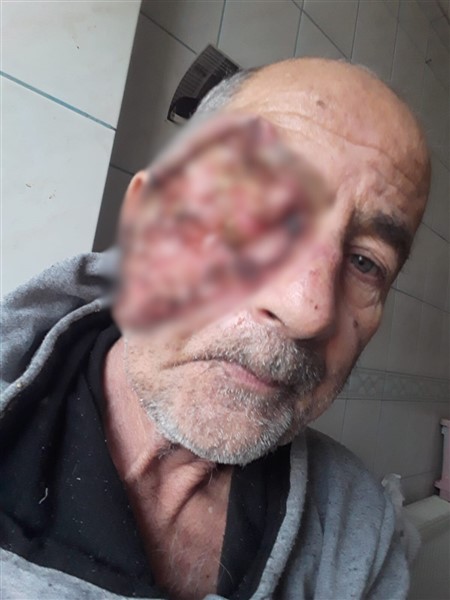 Yüzü eriyen adam tedavi olmak istiyor 