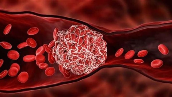 Yeni araştırma: A kan grubunun felç riski yüksek