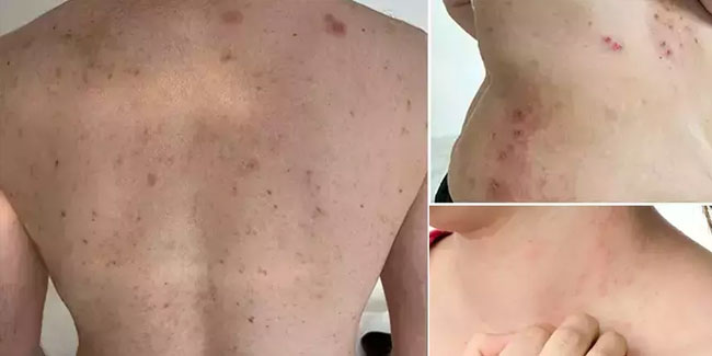 Uyuz alarmı! Vakalar artıyor