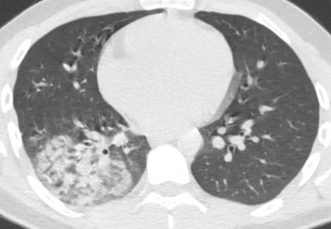 Ne influenza ne covid! Klima zatürresi