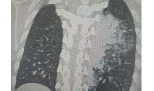 Türkiye’deki yeni salgın alarm veriyor