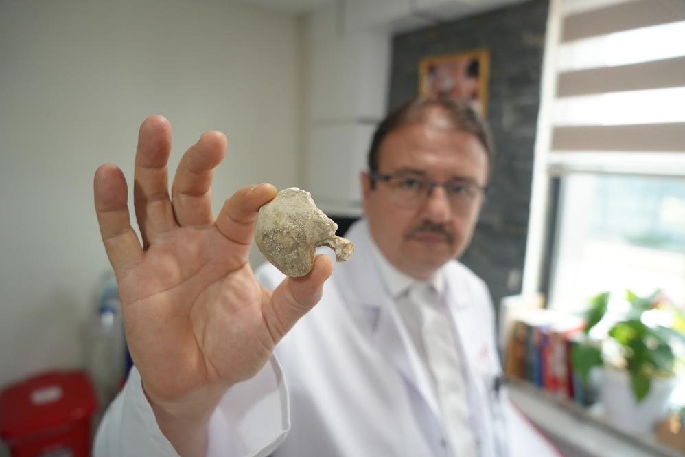 Samsun'da hastaların taşları doktorun koleksiyonu oldu