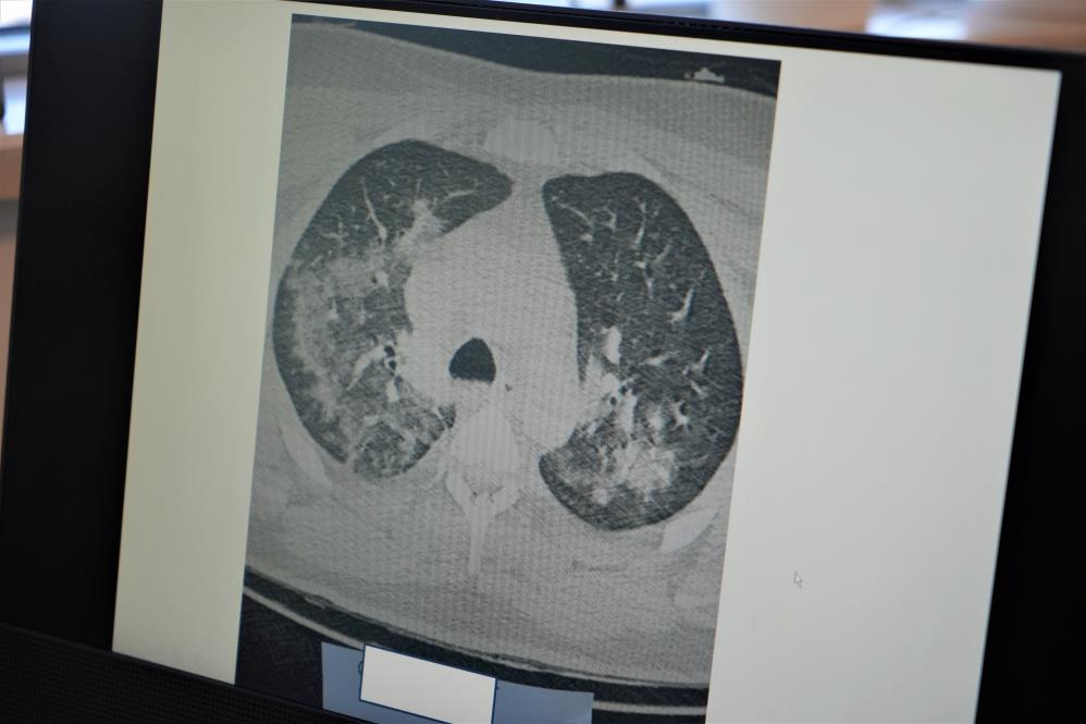 Şevket Özkaya: Kalp krizi vakalarının sebebi Kovid-19 olabilir