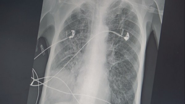 Sigaranın Ölümcül Etkileri: KOAH ve Akciğer Kanseri