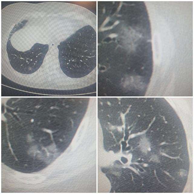 Uyarı Samsun'dan geldi! Covid-19 vakalarında 'yaz sonu dalgası' mı?