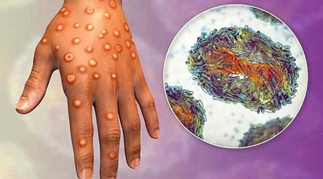 Maymun çiçeği virüsü yayılıyor: Bir ülkeye daha sıçradı. Türkiye’de de görüldü mü? Samsun’da da varmı?