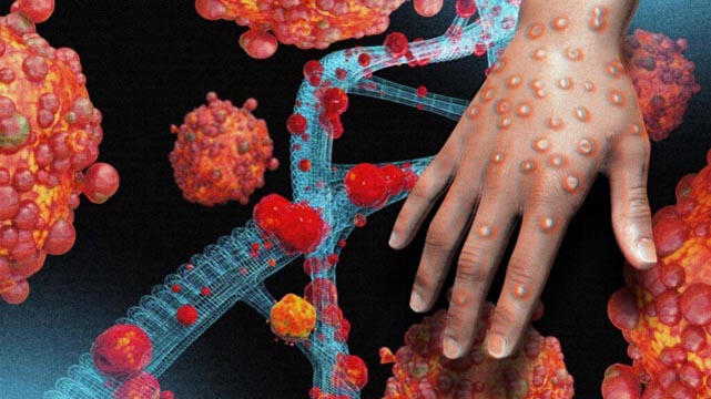 Maymun çiçeği virüsü yayılıyor: Bir ülkeye daha sıçradı. Türkiye’de de görüldü mü? Samsun’da da varmı?