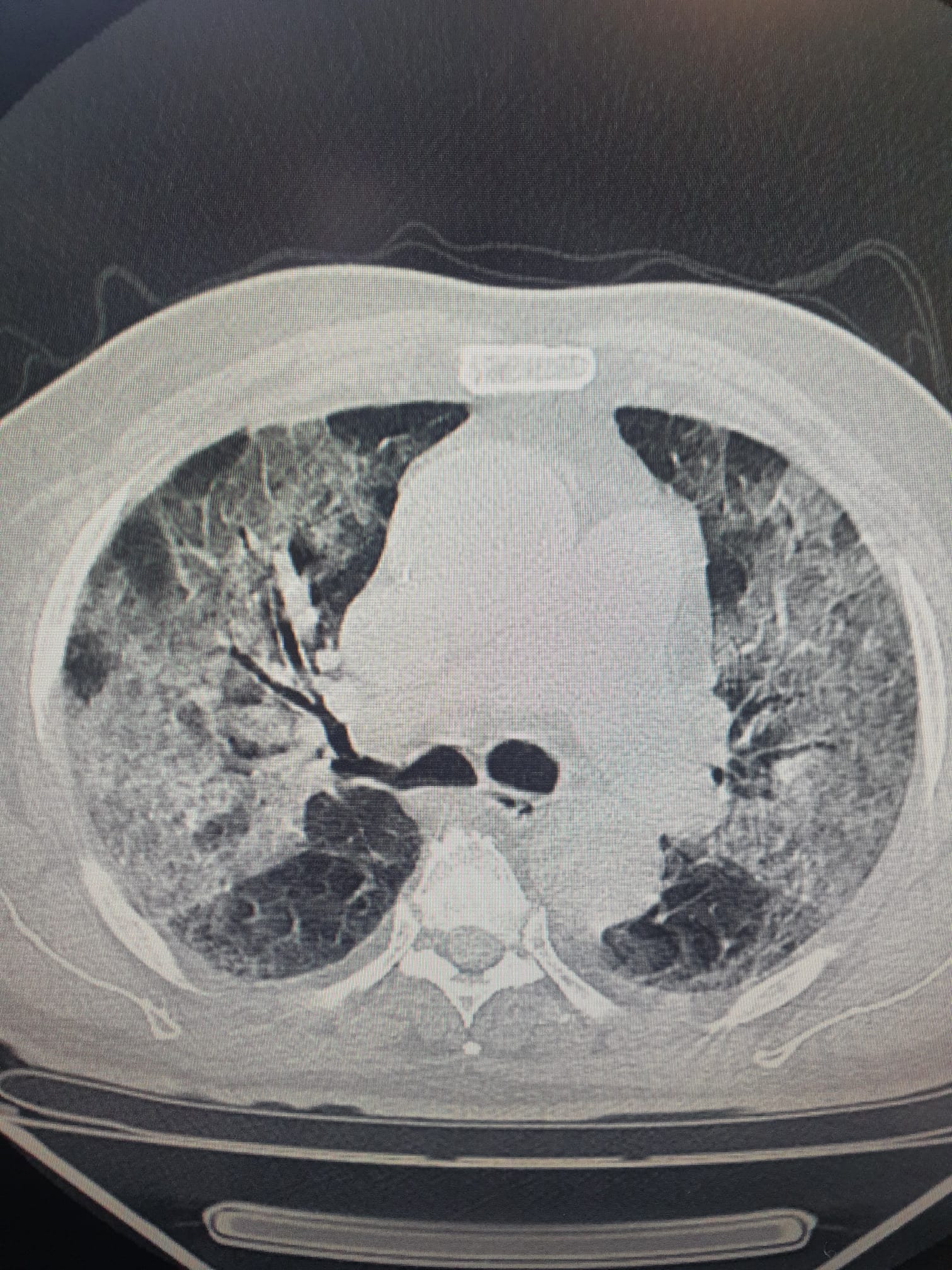 Samsun'da Covid öldürmeye devam ediyor