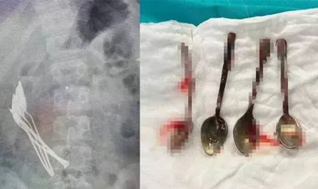 15 yaşındaki çocuğun midesinden 4 kaşık ve 1 çivi çıktı