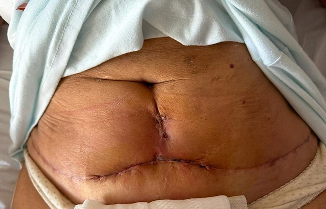 Samsun'da estetik ameliyat kabusu! 300 Bin TL'ye ameliyat oldu, iz kaldı