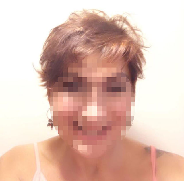 Samsun'da estetik ameliyat kabusu! 300 Bin TL'ye ameliyat oldu, iz kaldı