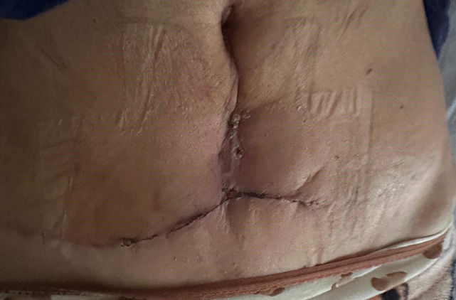 Samsun'da estetik ameliyat kabusu! 300 Bin TL'ye ameliyat oldu, iz kaldı