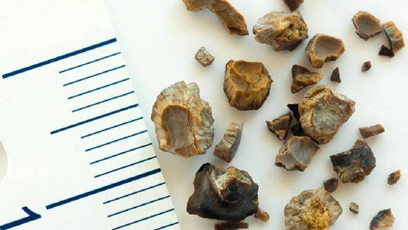 Erkeklerde daha fazla görülüyor: İdrarda kanama ve ağrıya dikkat!