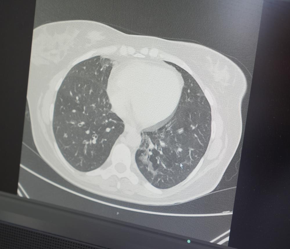 Şevket Özkaya uyardı! Pandemi sonrası akciğer ve kalp sağlığına dikkat