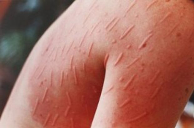 Uyuz vakasında büyük tehdit: Yüzde 300 artış!