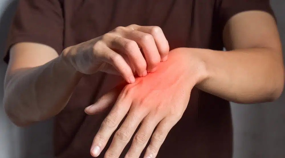 Uyuz vakasında büyük tehdit: Yüzde 300 artış!