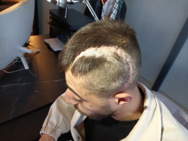 Patronundan dayak yiyen Nail Baran engelli kaldı