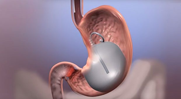 Mide balonu Türkiye'de durduruldu: TICK'dan açıklama