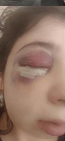 Samsun'da yolda yürürken sözlü tacize uğradı ve darp edildi! Damla Korkmaz dehşet anlarını anlattı