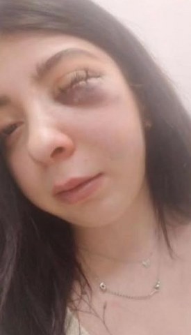 Samsun'da yolda yürürken sözlü tacize uğradı ve darp edildi! Damla Korkmaz dehşet anlarını anlattı