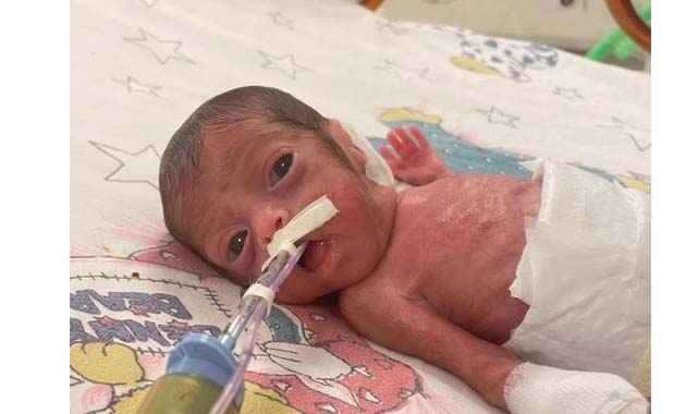 Samsun’da parmak bebek Aylin hayata tutundu