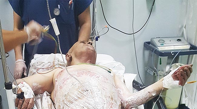 Sigaradan elbiseleri tutuştu, yanarak ağır yaralandı