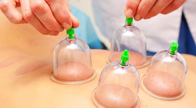 Hacamat nedir, nasıl yapılır faydaları ve zararları nelerdir?