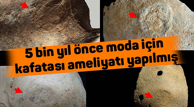 5 bin yıl önce moda için  kafatası ameliyatı yapılmış