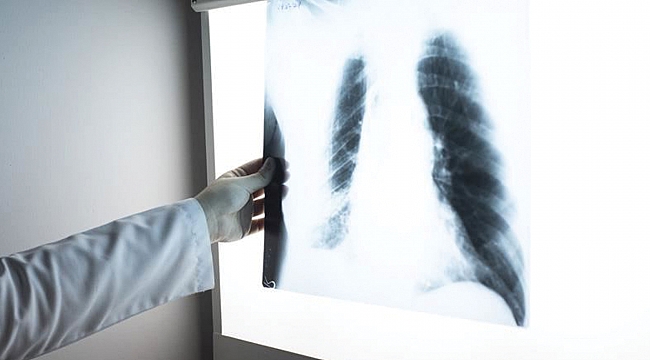 Tüm kanser ölümlerinin  yüzde 25'ini oluşturuyor