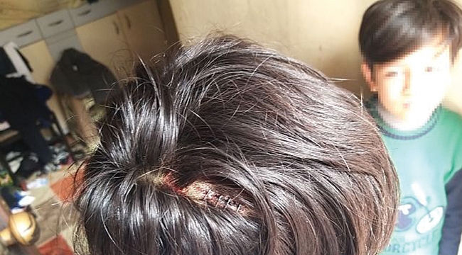 KARDEŞİ OYUN YÜZÜNDEN KAFASINI YARMIŞTI