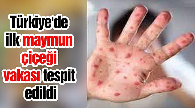 Türkiye'de ilk maymun çiçeği vakası tespit edildi