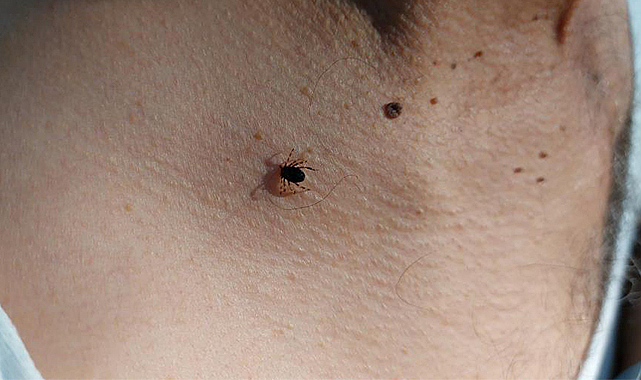 Boynuna tutunan kene hastanede çıkartıldı