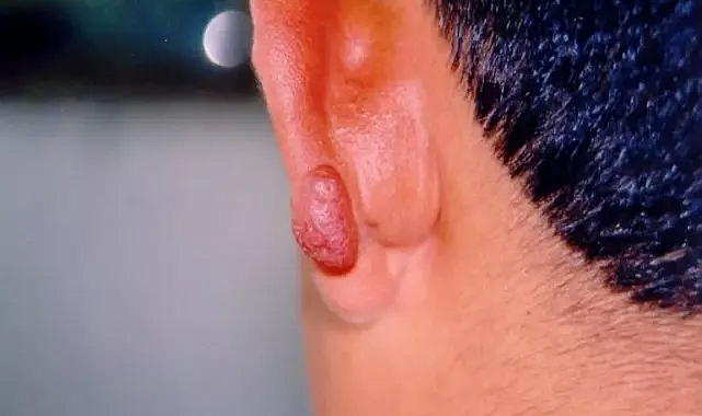 Kan emen kum sineğine dikkat, dalak ve karaciğeri vuruyor