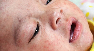 Samsun'da vaka sayısı 500'e ulaştı! Kızamık salgını var