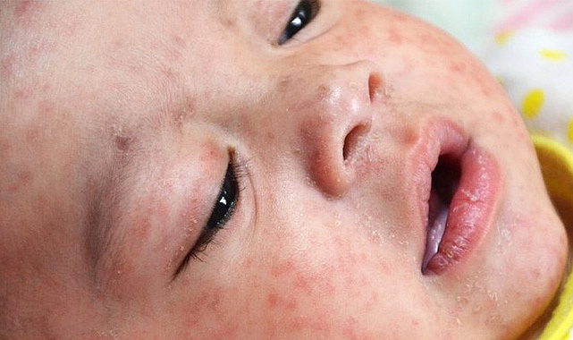 Samsun'da vaka sayısı 500'e ulaştı! Kızamık salgını var