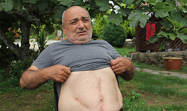 18 yıl boyunca karnında unutulan 3 parça gazlı bezle yaşadı