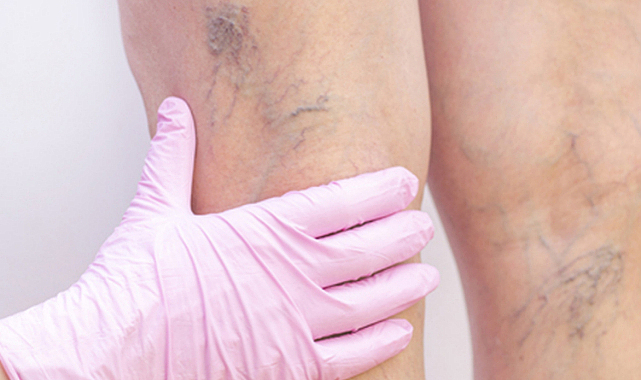 Sıcak havalarda bu hastalığa dikkat!