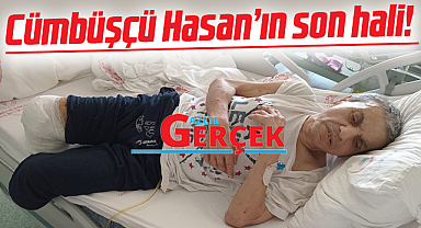 Samsun'da Cümbüşçü Hasan'ın sol bacağının ardından sağ bacağıda kesildi
