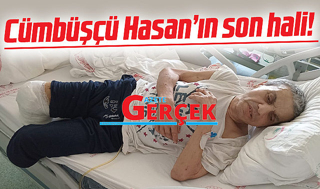 Samsun'da Cümbüşçü Hasan'ın sol bacağının ardından sağ bacağıda kesildi