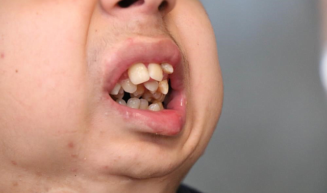 Samsun'da alt çenesi olmayan genç ameliyat için yardım bekliyor