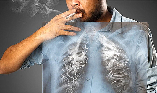 Sigara içenlere uzmanlardan uyarı 'Akciğer filmi çektirin'