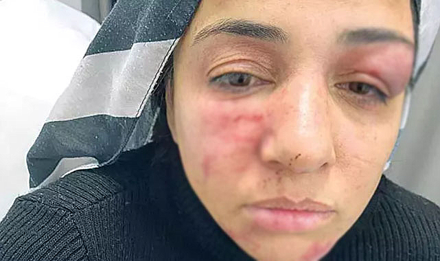 Songül Kaya, sokak ortasında sopalı saldırıya uğradı